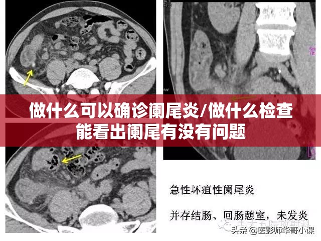 做什么可以确诊阑尾炎/做什么检查能看出阑尾有没有问题