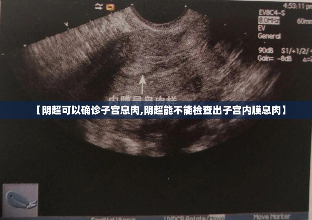 【阴超可以确诊子宫息肉,阴超能不能检查出子宫内膜息肉】 【阴超可以确诊子宫息肉,阴超能不能检查出子宫内膜息肉】