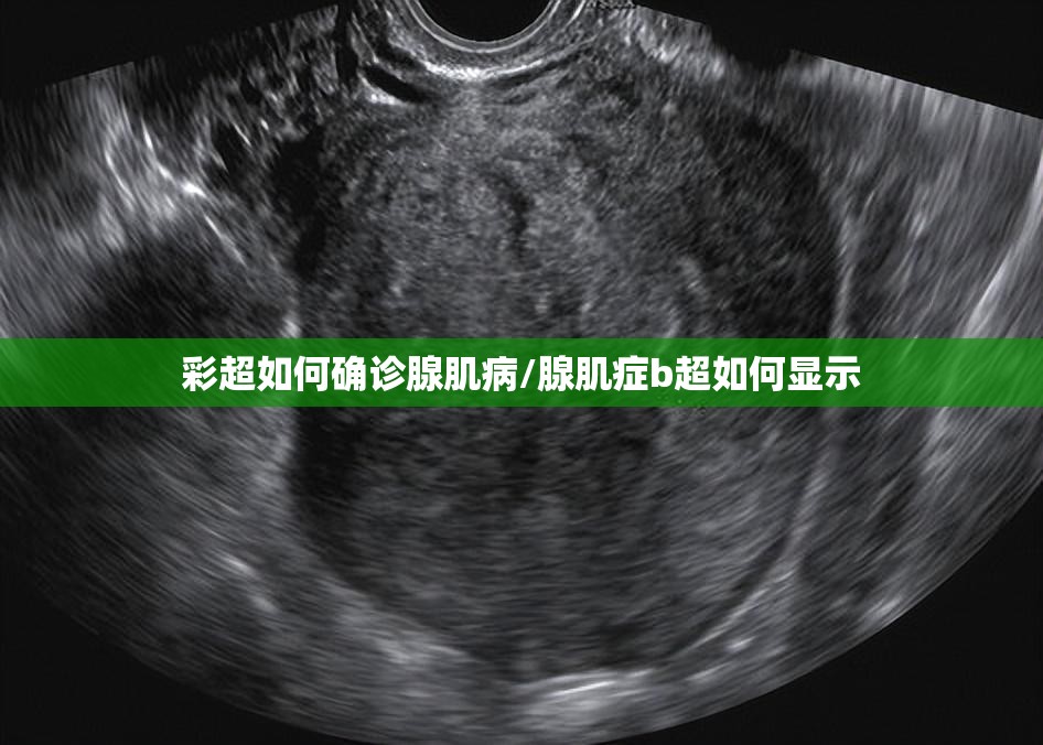 彩超如何确诊腺肌病/腺肌症b超如何显示 彩超如何确诊腺肌病/腺肌症b超如何显示