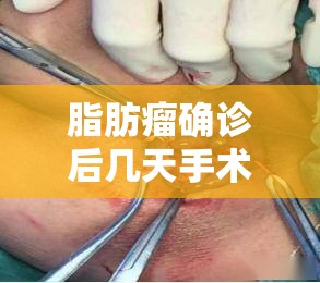 脂肪瘤确诊后几天手术/脂肪瘤手术在院观察要多久 脂肪瘤确诊后几天手术/脂肪瘤手术在院观察要多久