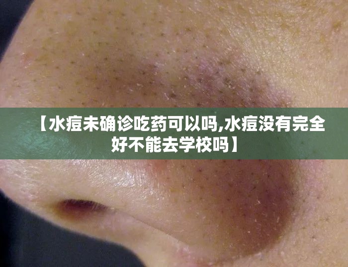 【水痘未确诊吃药可以吗,水痘没有完全好不能去学校吗】 【水痘未确诊吃药可以吗,水痘没有完全好不能去学校吗】