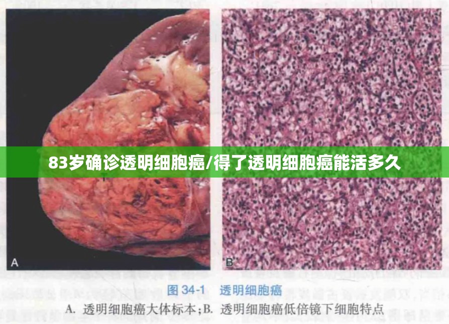 83岁确诊透明细胞癌/得了透明细胞癌能活多久