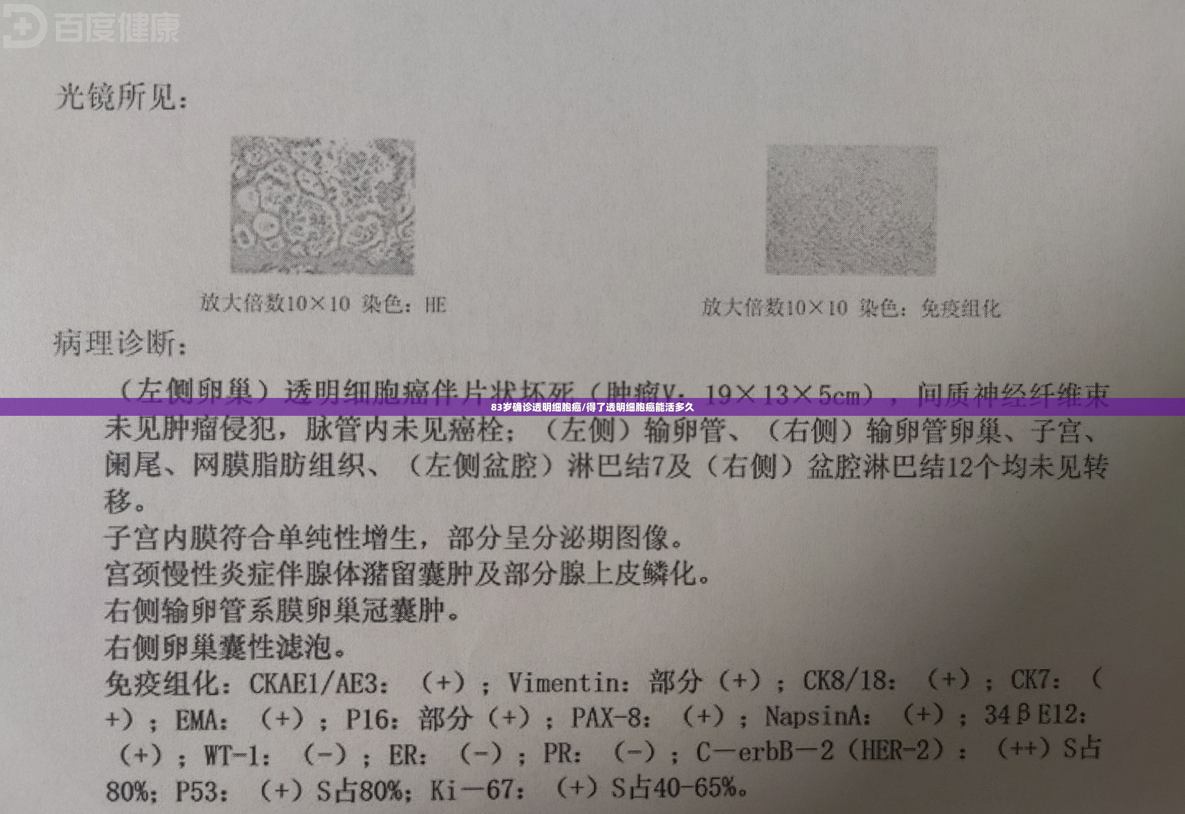 83岁确诊透明细胞癌/得了透明细胞癌能活多久 83岁确诊透明细胞癌/得了透明细胞癌能活多久