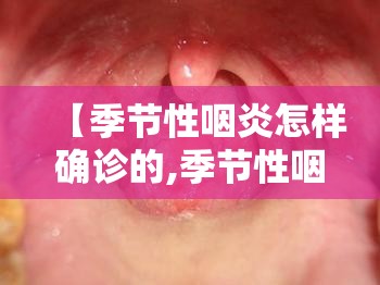 【季节性咽炎怎样确诊的,季节性咽喉炎治疗方法】 【季节性咽炎怎样确诊的,季节性咽喉炎治疗方法】